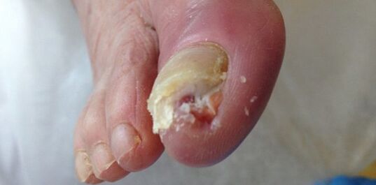 Rezervuaras ir dermatofitinių grybų šaltinis yra sergantis žmogus